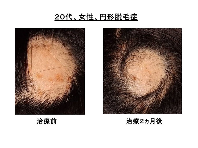 円形脱毛症　病院""
